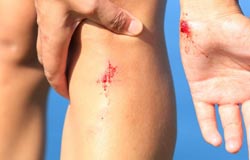 Apparato tegumentario: Ferite