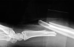 Apparato osteo-tendineo: Fratture